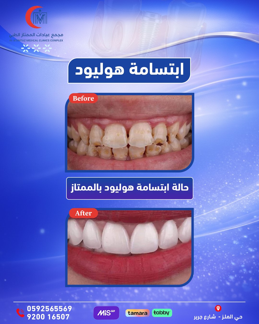 ابتسامة هوليود