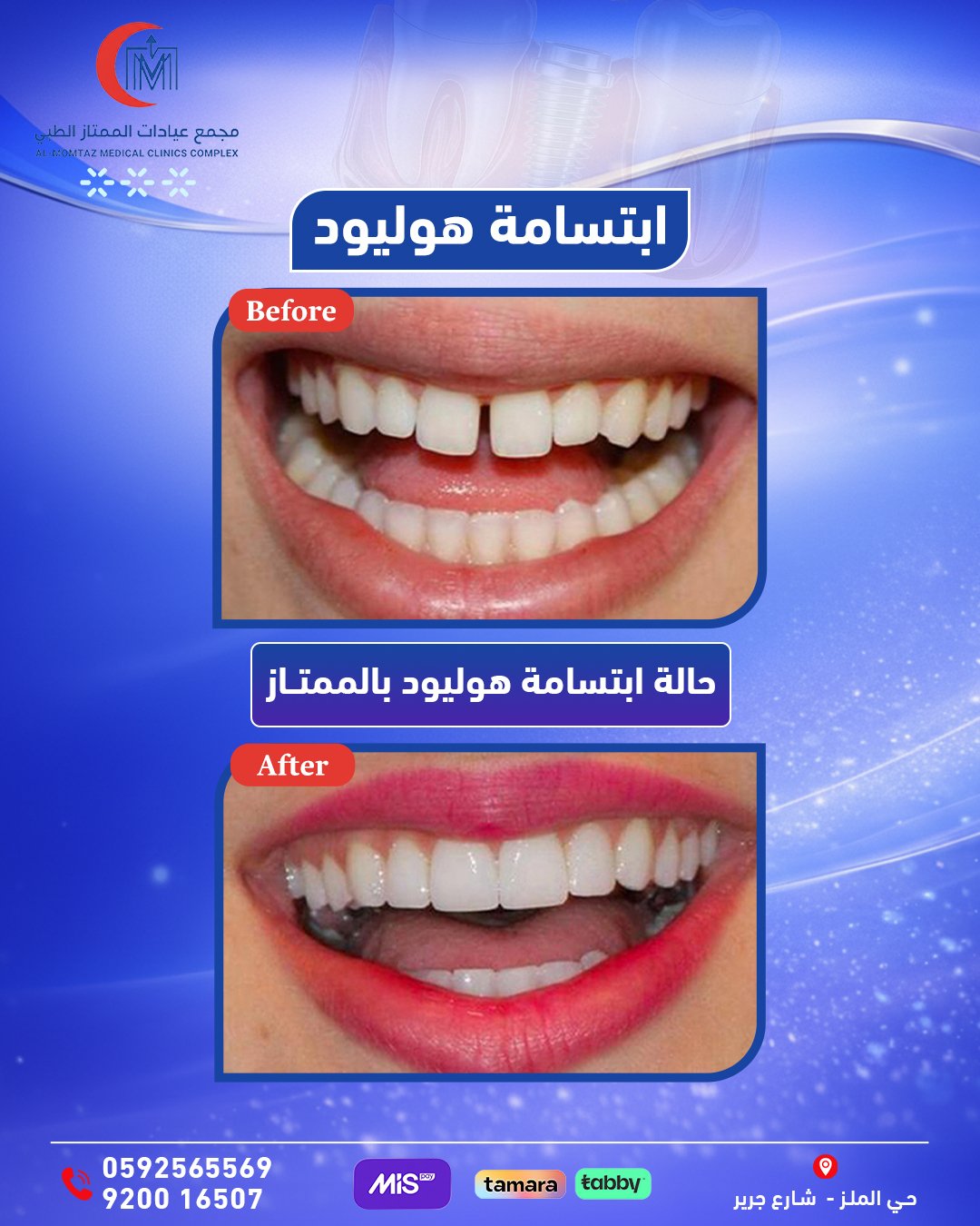 ابتسامة هوليود بديل التقويم