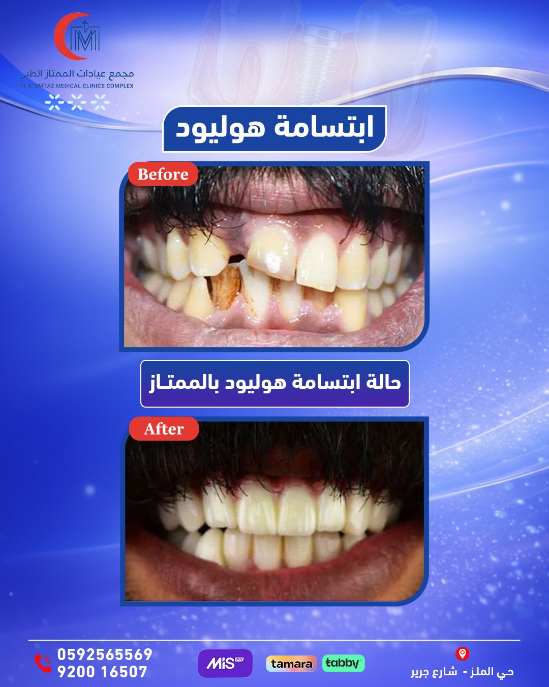 ابتسامة هوليود ألماني