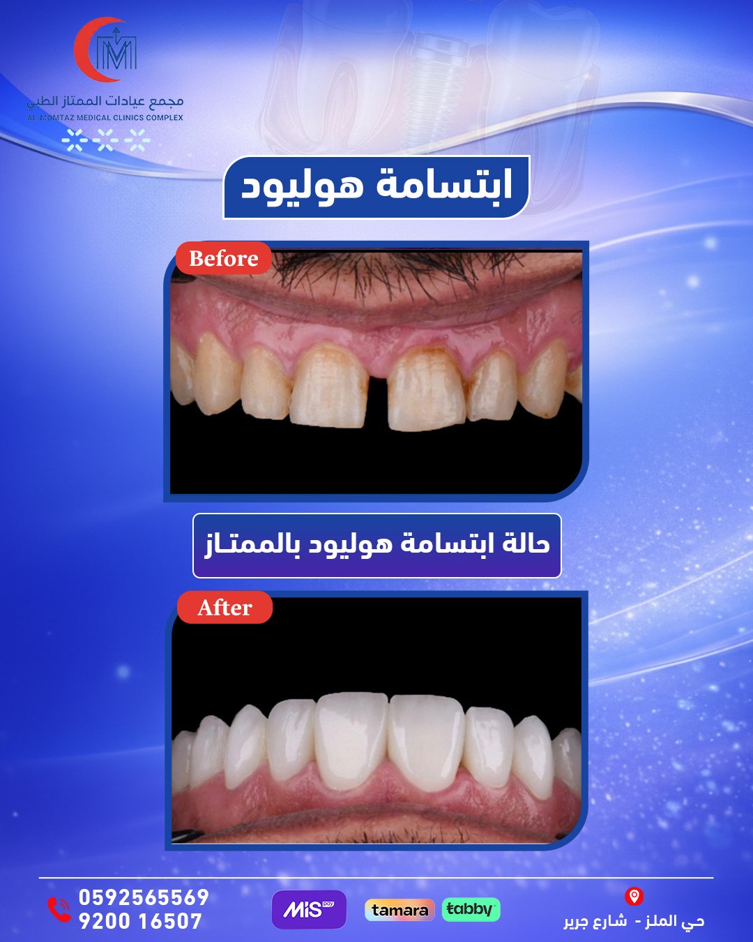 ابتسامة  هوليود 3D