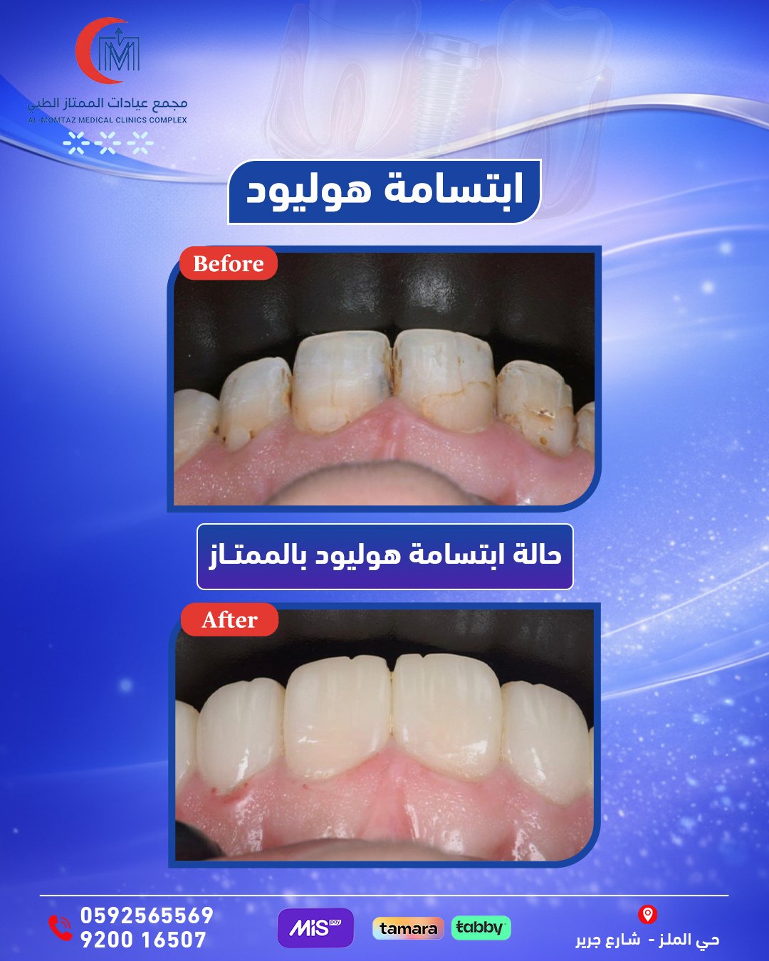 تركيب أسنان بنفس اللون