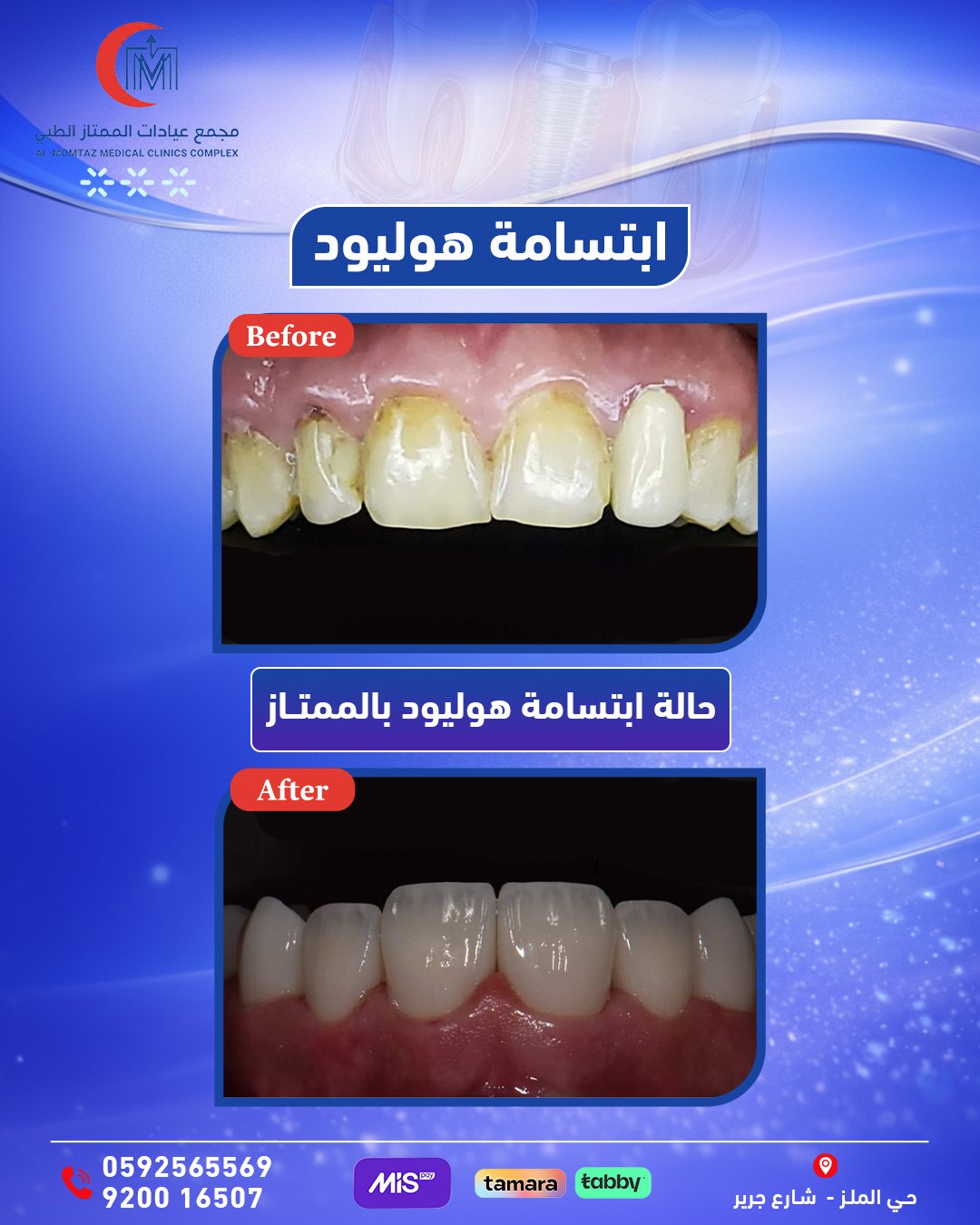 ابتسامة أرنبية