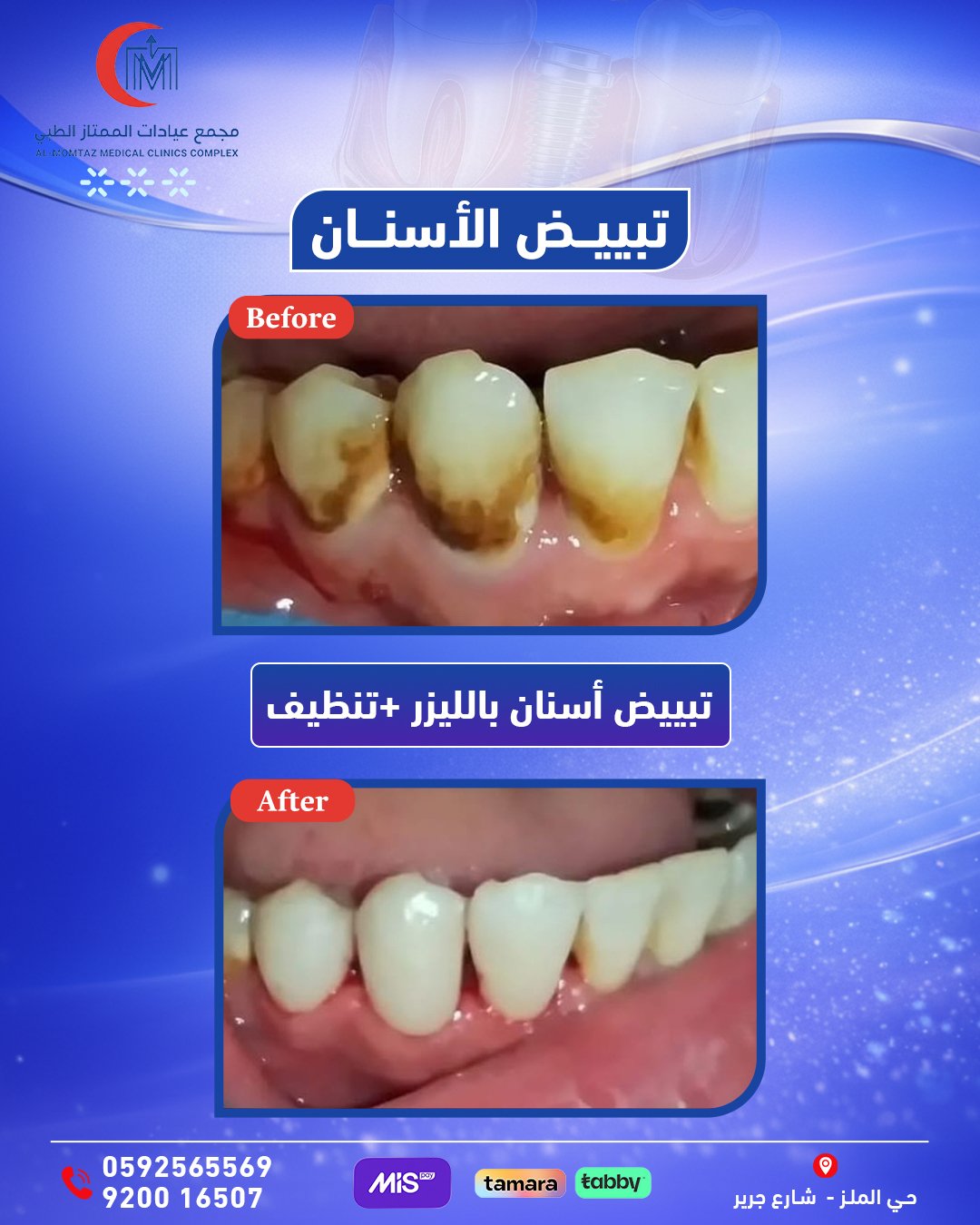 تبييض وتنظيف الأسنان