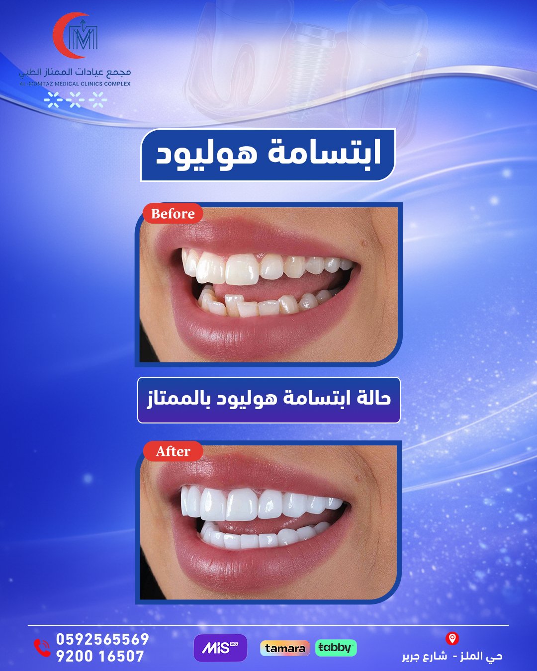 ابتسامة هوليود