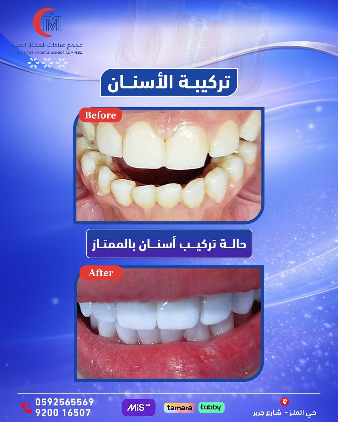 تركيب أسنان زيركون