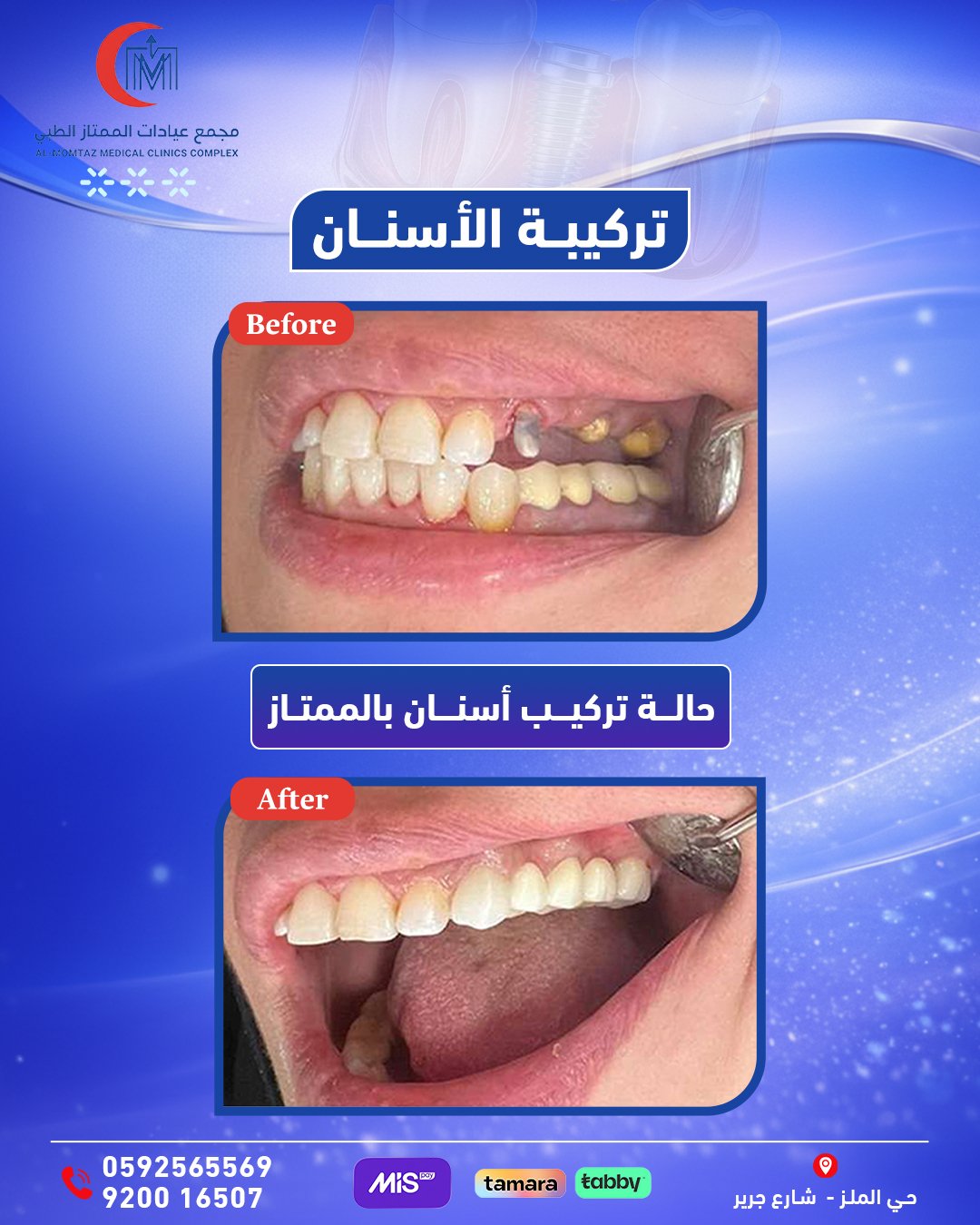 تركيبات أسنان خلفية