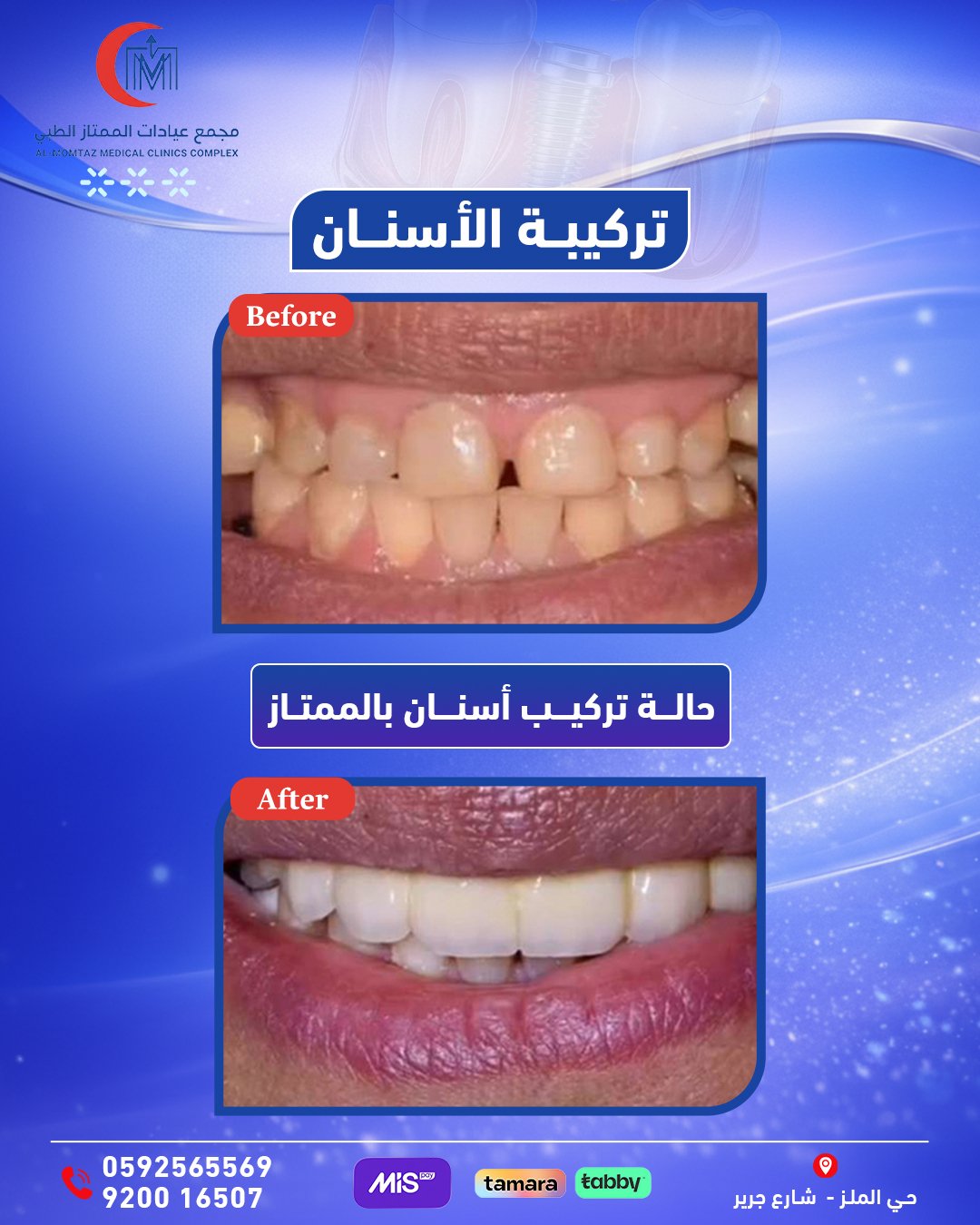 تركيب أسنان أمامية