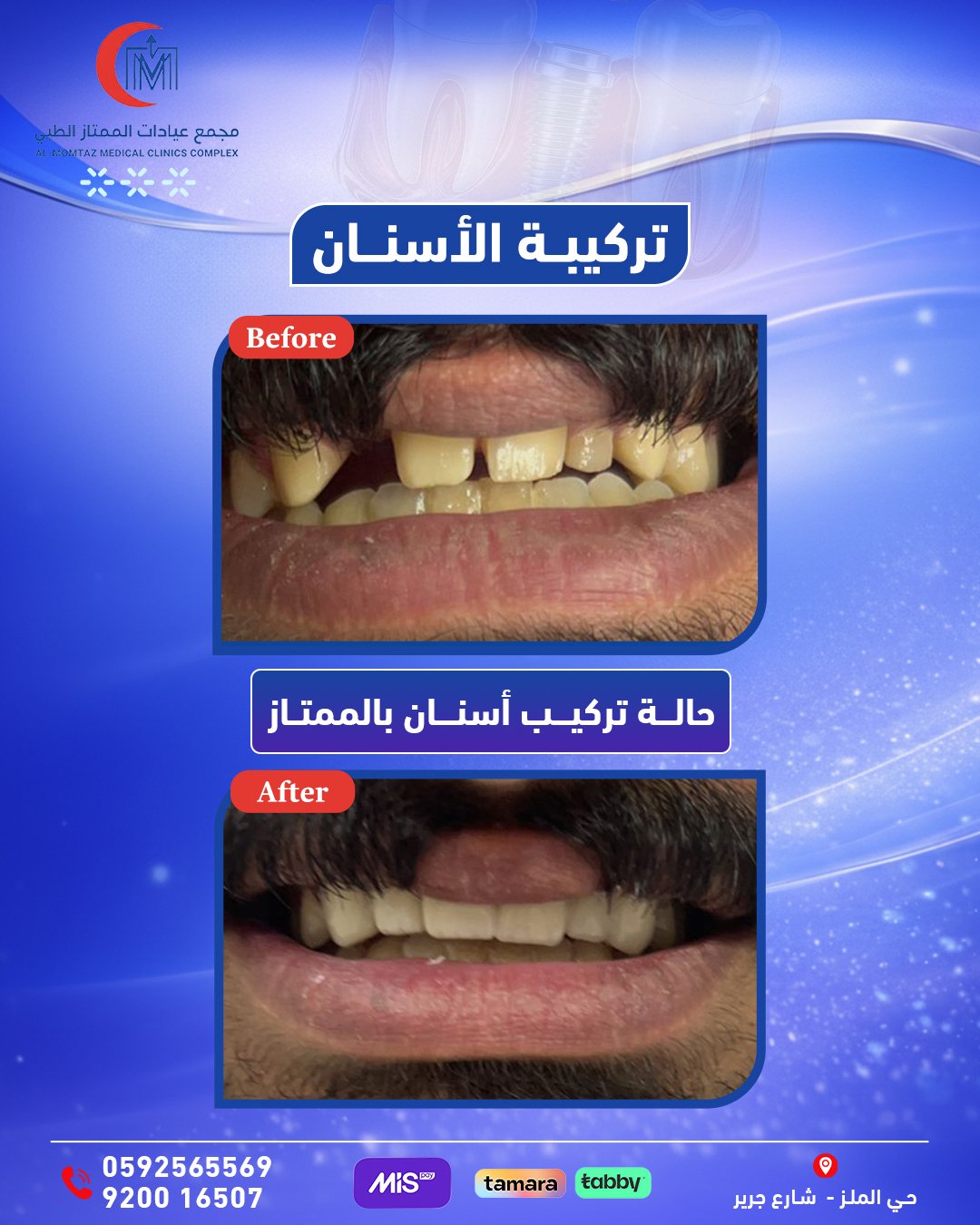 تركيب أسنان