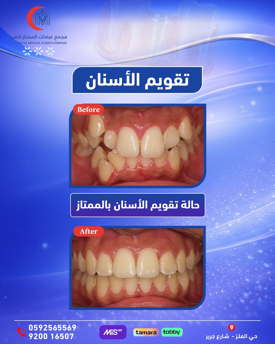 حالة تقويم أسنان بالممتاز