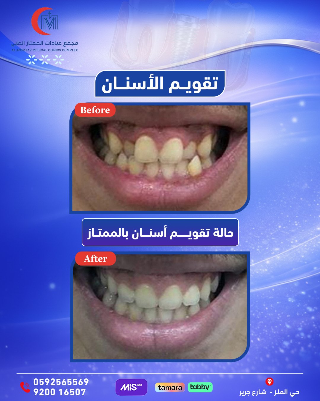 تقويم أسنان شفاف