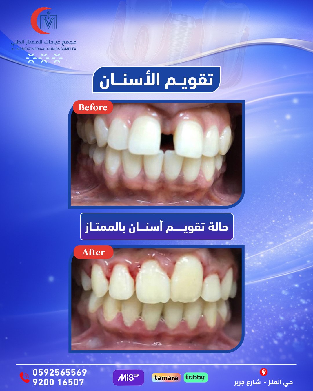 نتيجة تقويم الأسنان