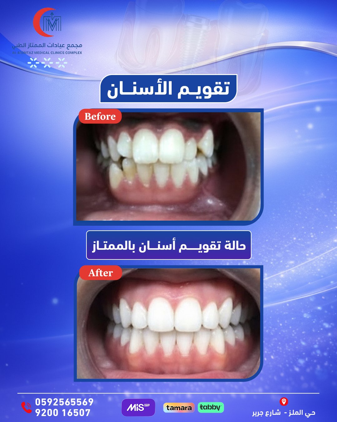 تقويم الأسنان