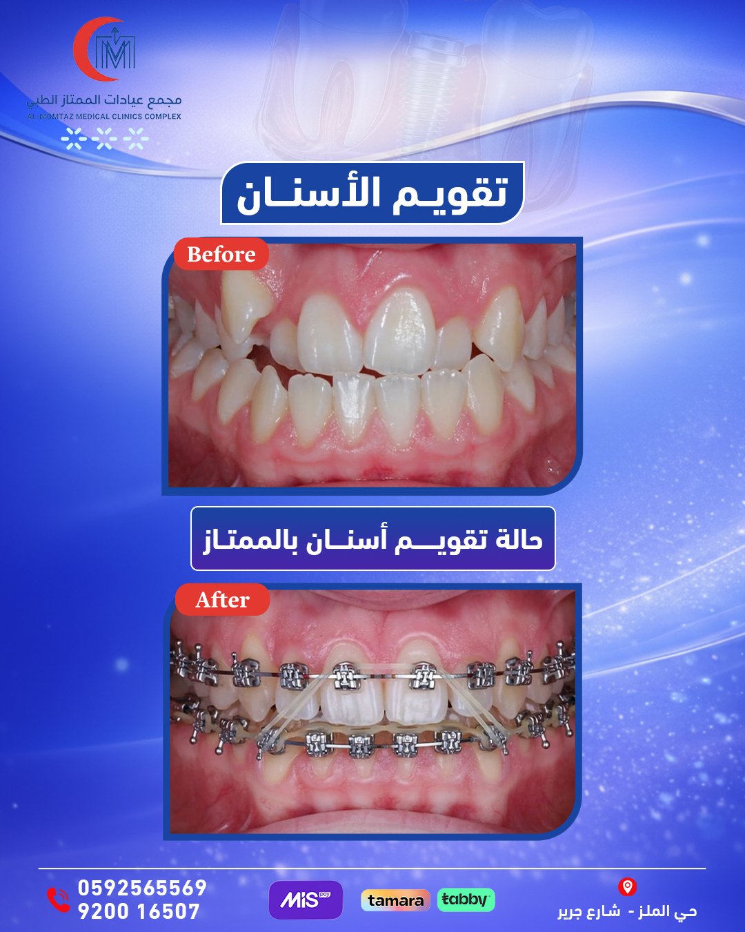 تقويم أسنان نتيجة 100%