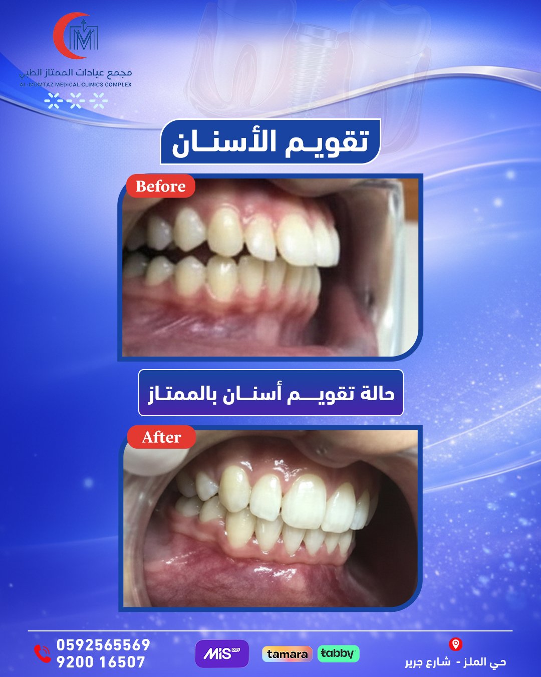 حالة تقويم أسنان
