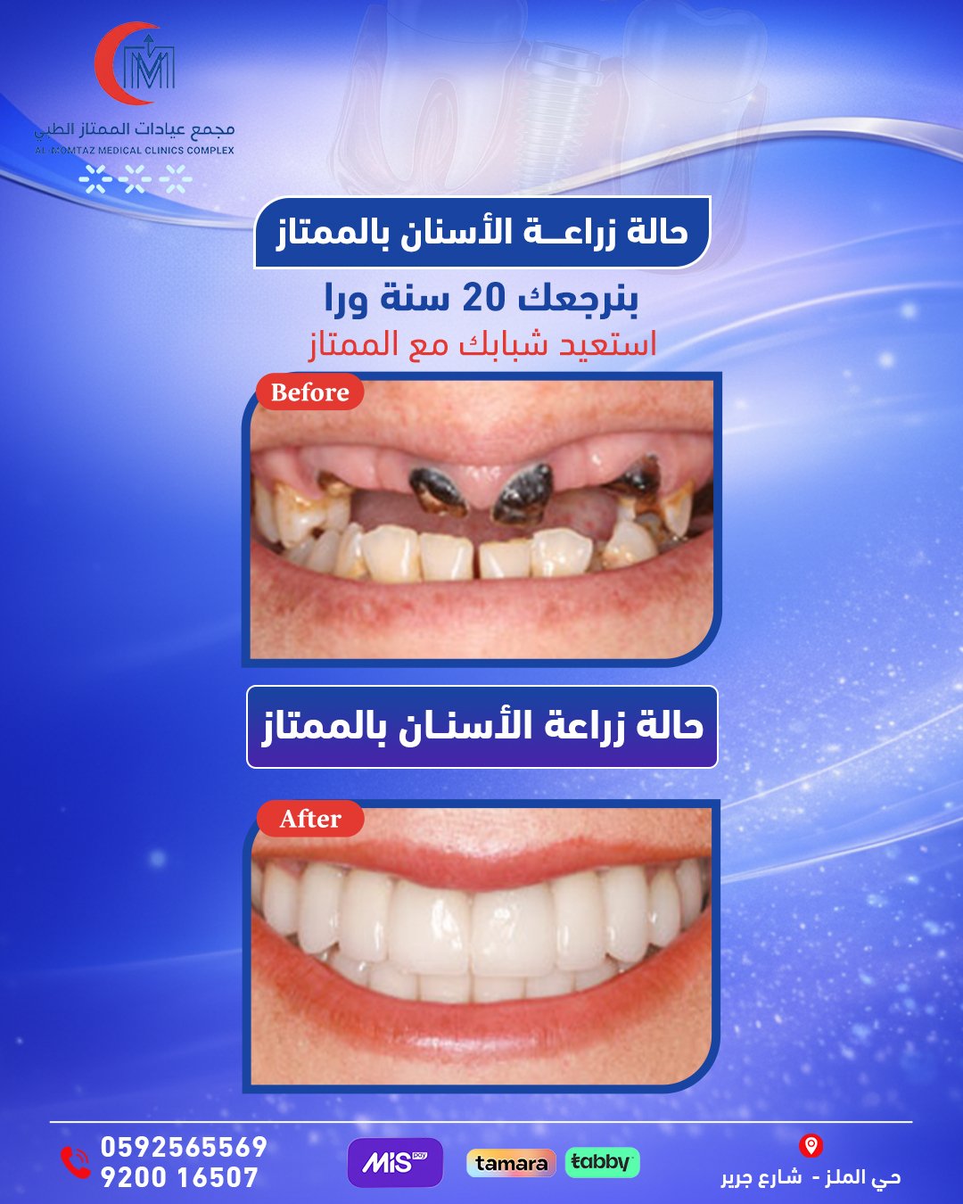 حالة زراعة أسنان