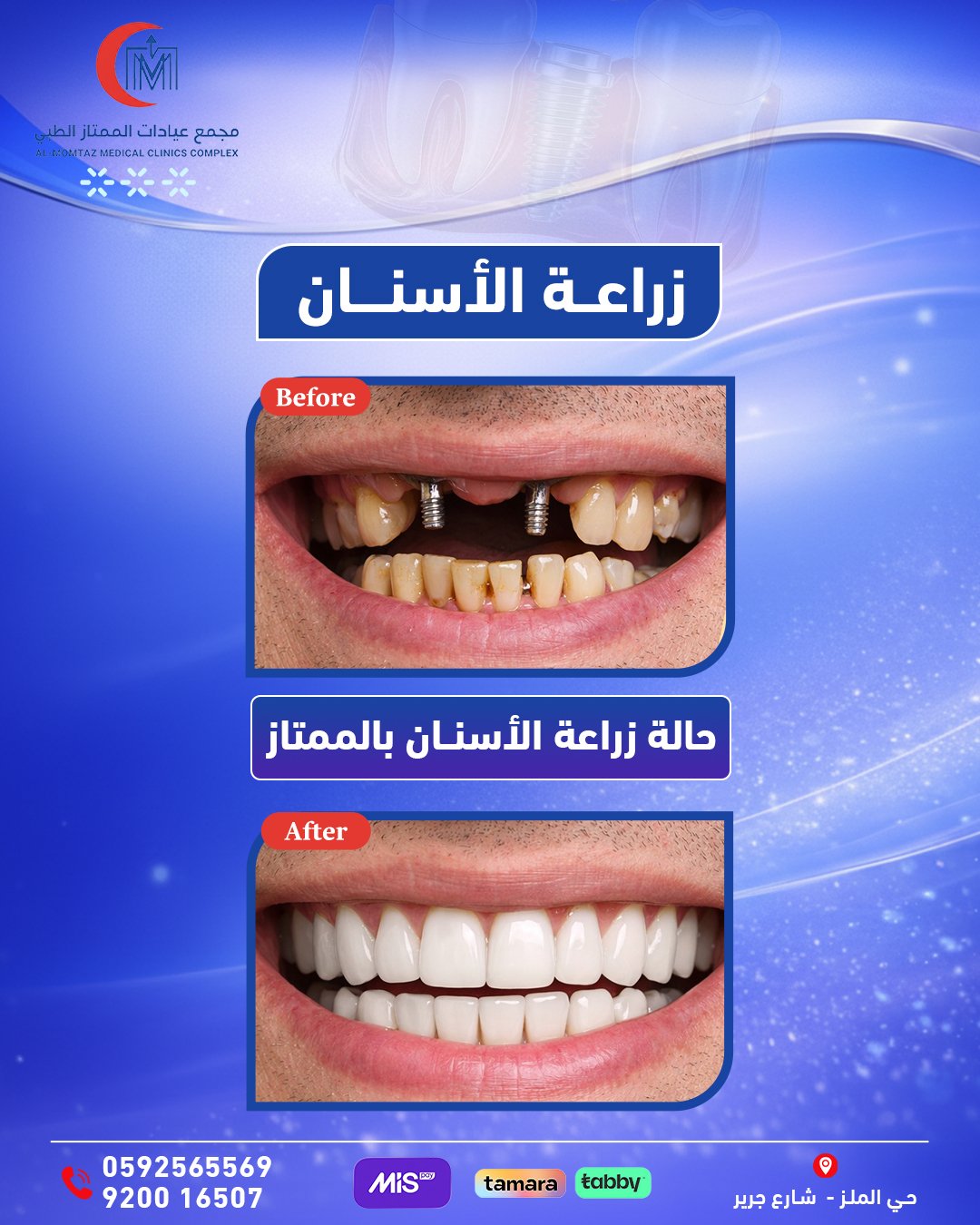 زراعة اسنان أمامية