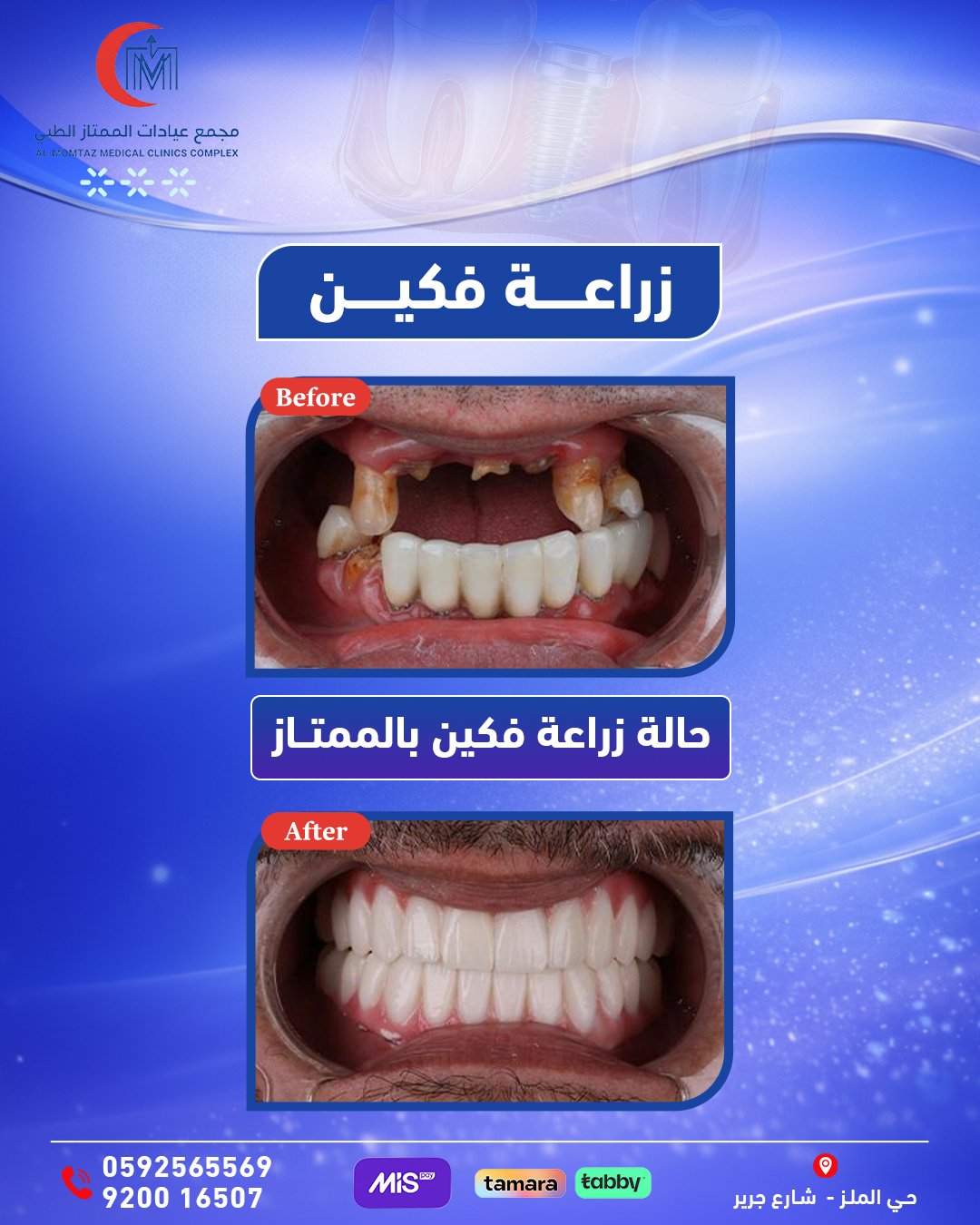 زراعة فكين