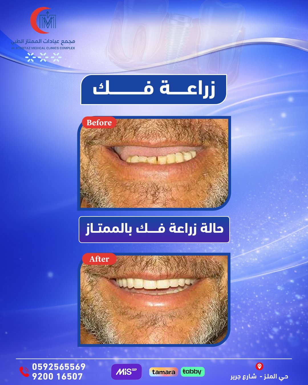 زراعة الأسنان