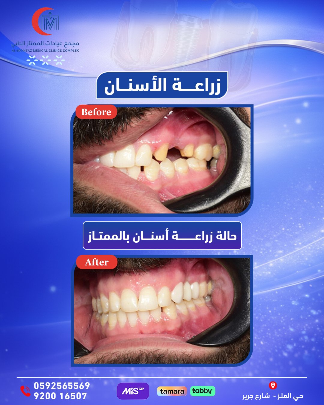 زراعة سن خلفي